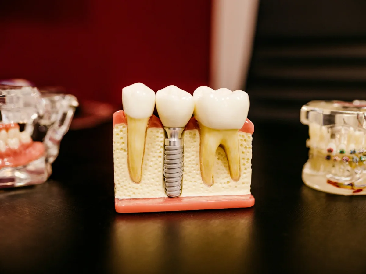 Implantes e reabilitação